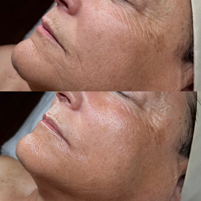 Korean Needle Free Filler Facial at Glow & Grace Skin Studio in Casper, Wyoming.