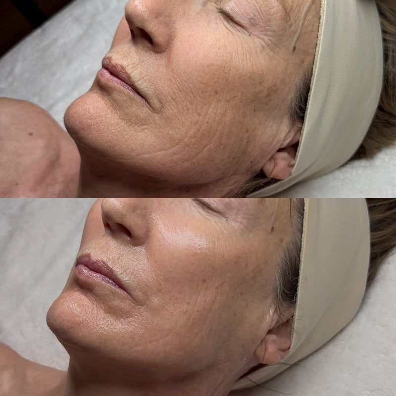 V- LINE Tightening Facial at Glow & Grace Skin Studio in Casper, Wyoming.